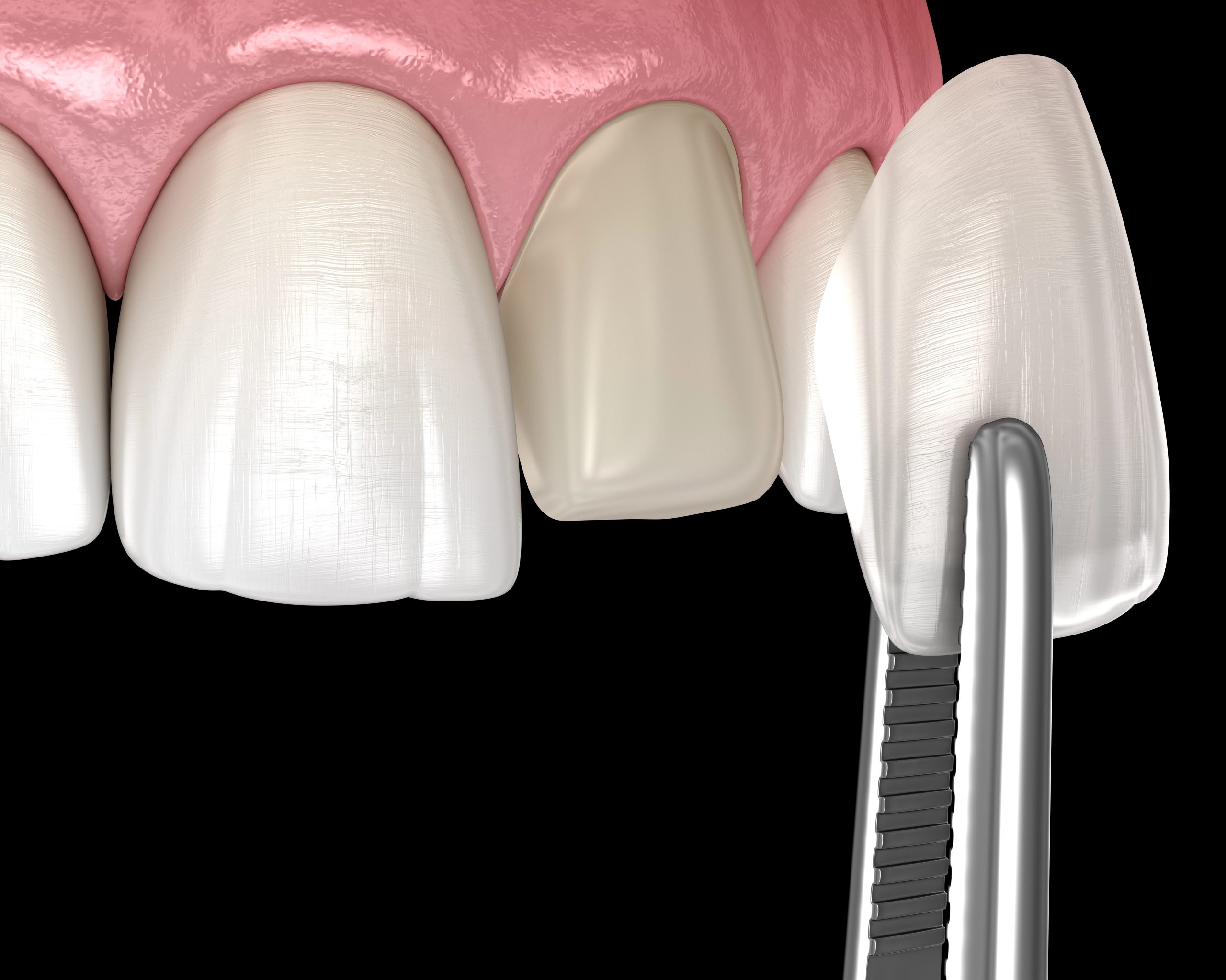 Dental Veneer Durability Over Time: How Long Will They Last?