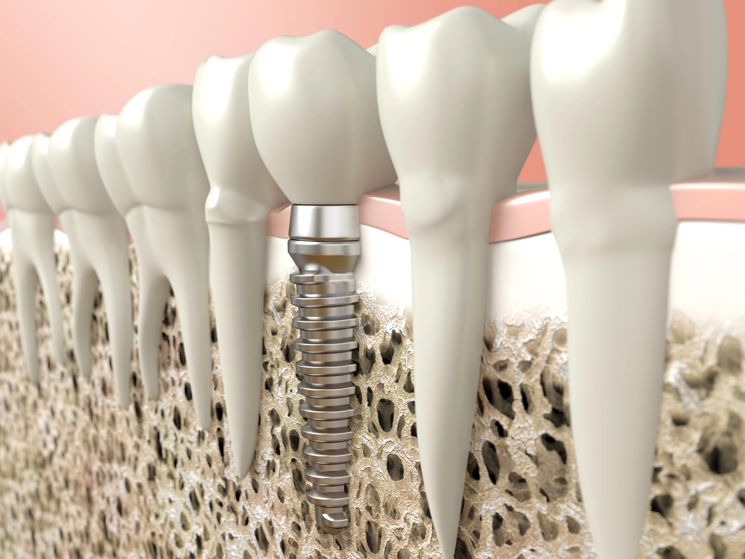 Discover the Lasting Benefits of Dental Implants Near You