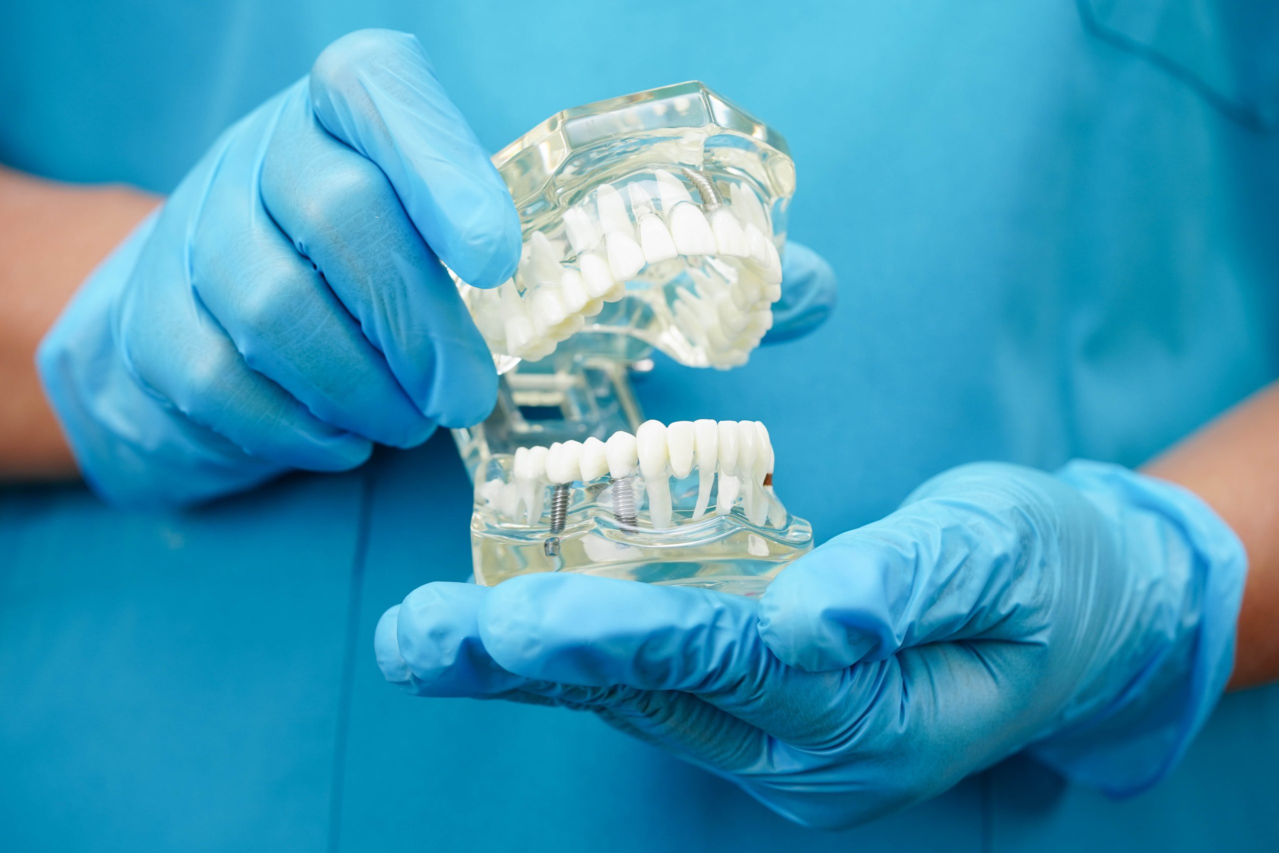Why Implant Supported Dentures Are a Game-Changer for Your Smile