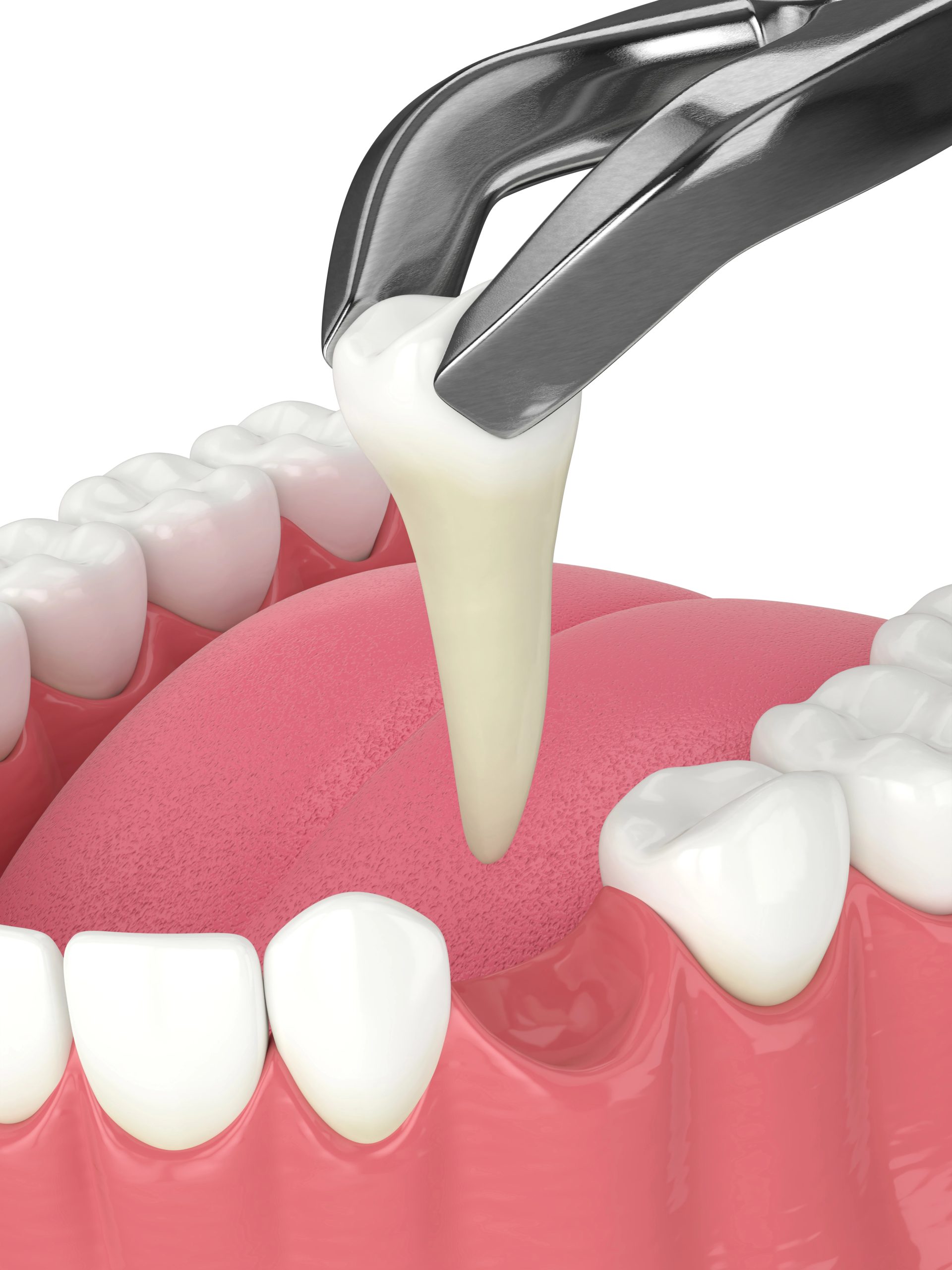 Discover the Unexpected Benefits of Wisdom Teeth Removal for Your Oral Health