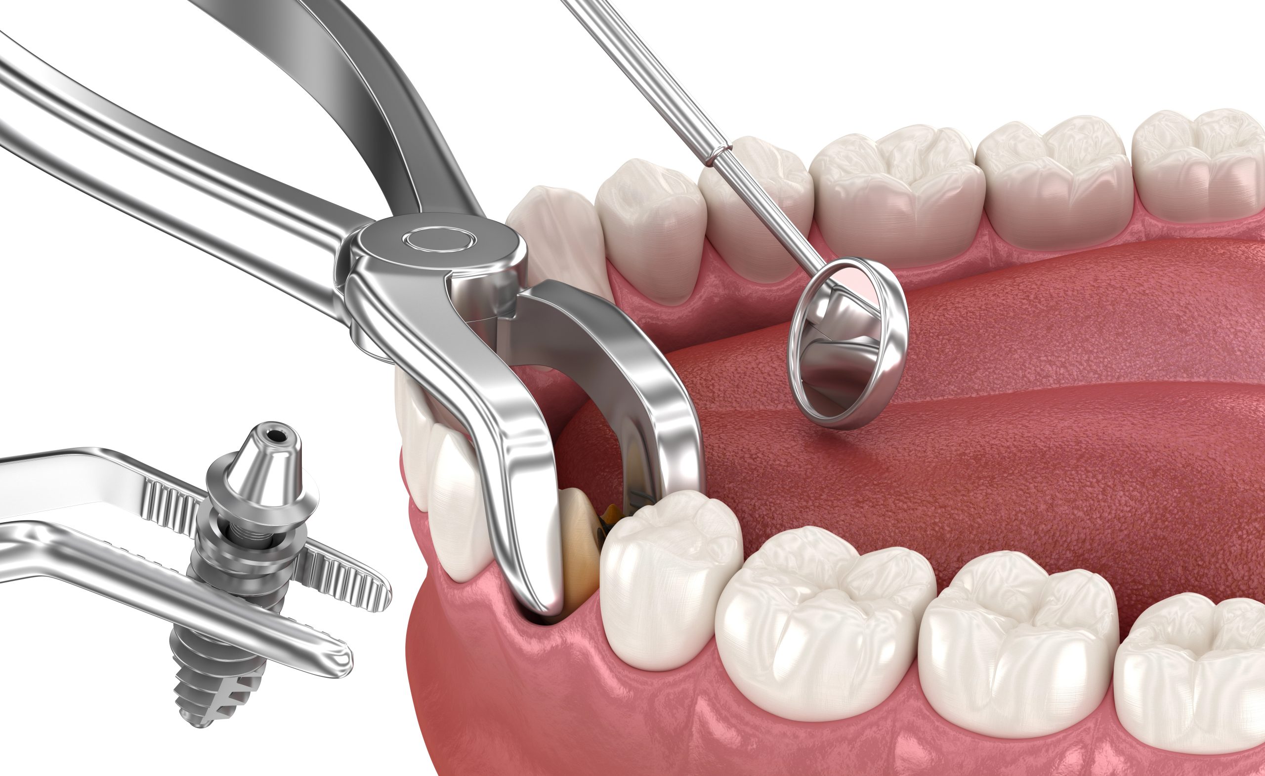 Top 5 Essential Questions to Ask Your Dentist Before Wisdom Teeth Removal