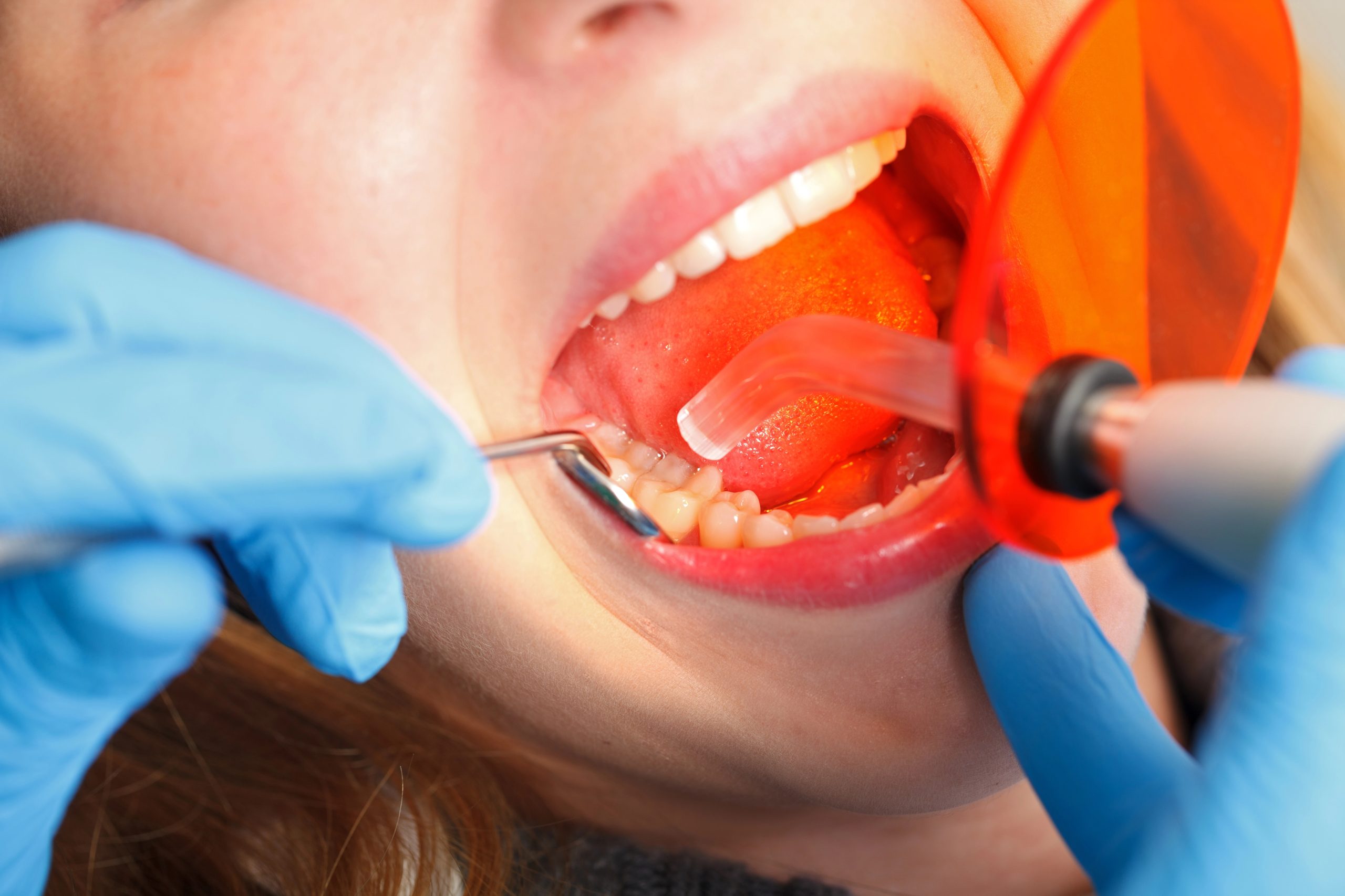 Can Modern Dental Fillings Really Look and Feel Like Your Natural Teeth?