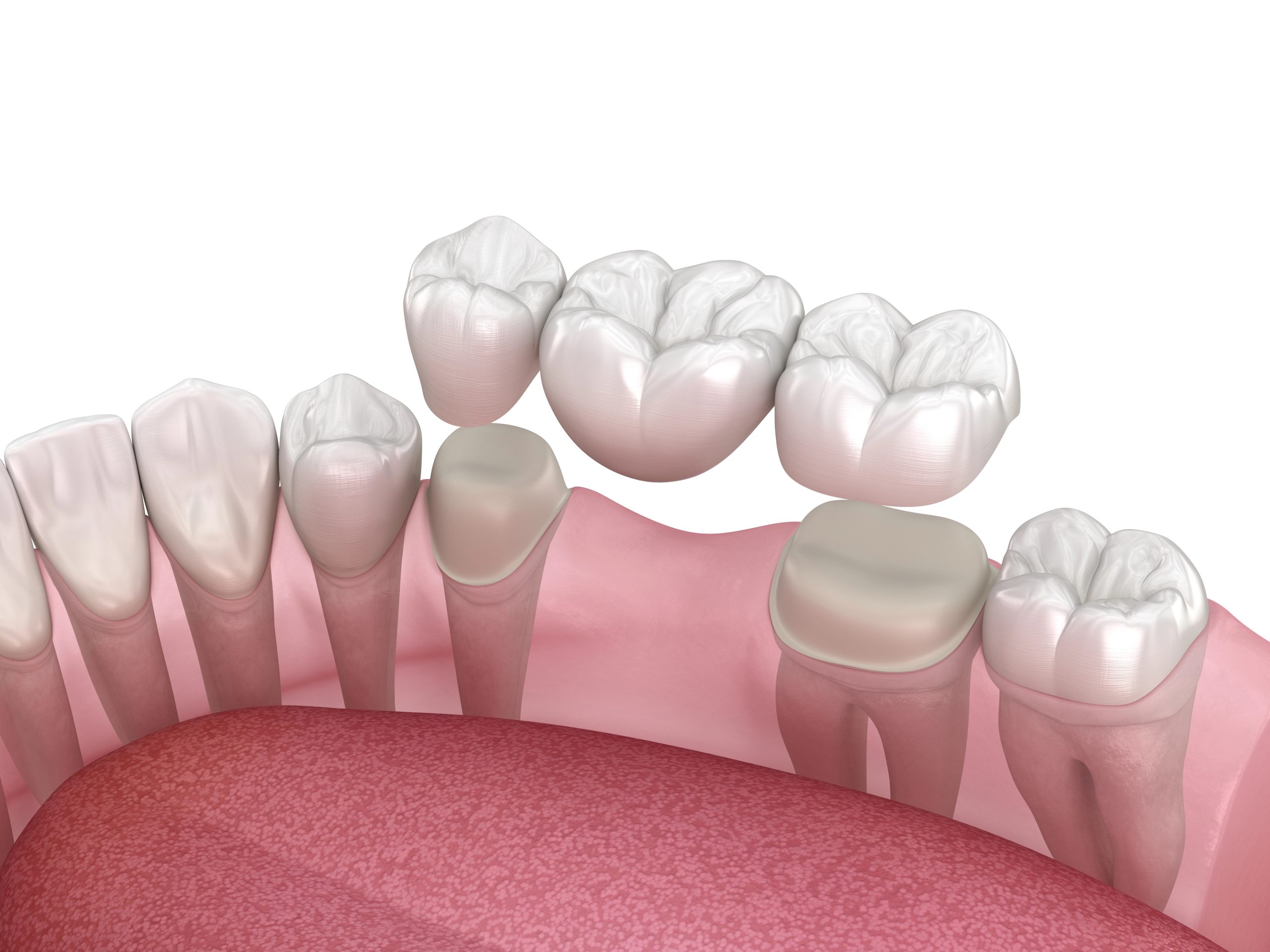 How Long Will Your Dental Bridge Actually Last in Winter Garden?