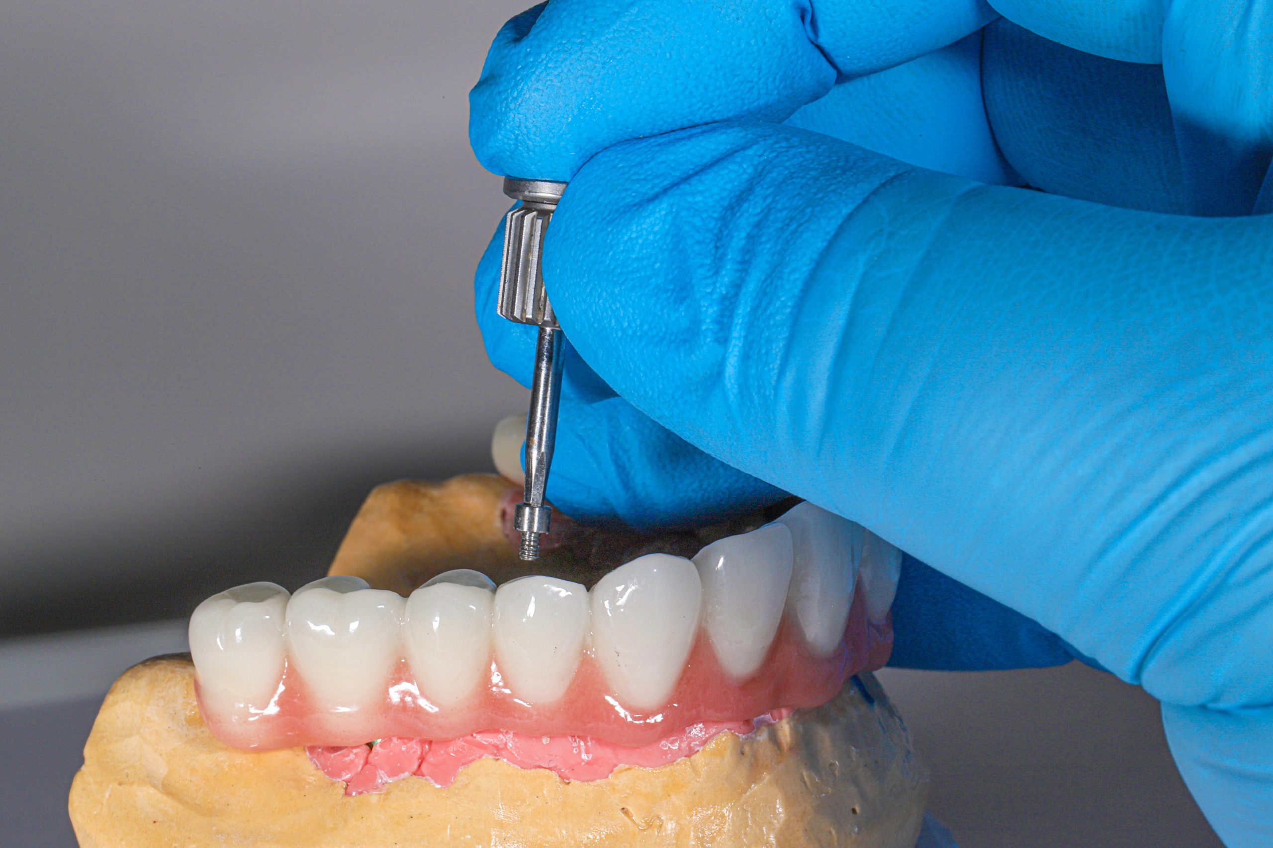 What’s Actually Happening During Your Bone Grafting Procedure at Sapphire Dental Studio?