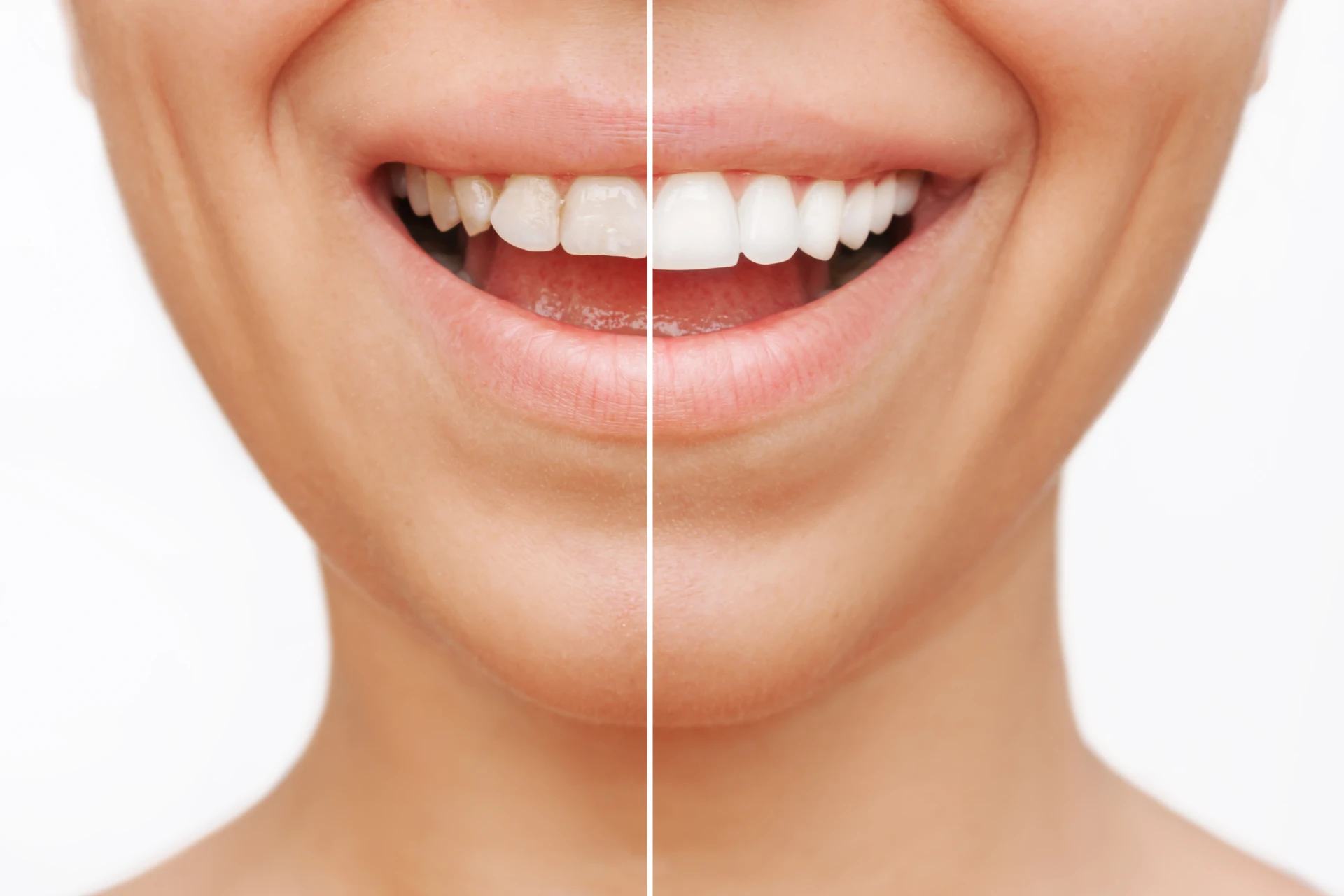 The All-on-X “Smile Reset”: Your Top 5 Questions Answered